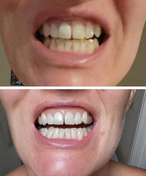 Bandes blanchissantes Louvaro Smile - Kit