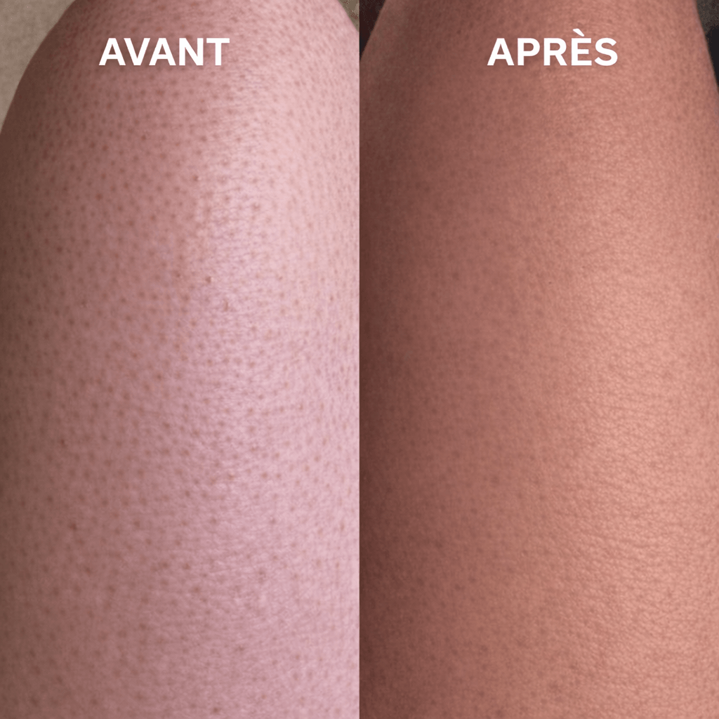 Gant exfoliant kératose pilaire - Louvaro™