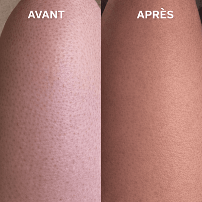 Gant exfoliant kératose pilaire - Louvaro™